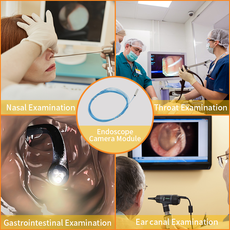 Analysis of Core Advantages of Side-View Endoscope Camera Module in Hysteroscope Applications