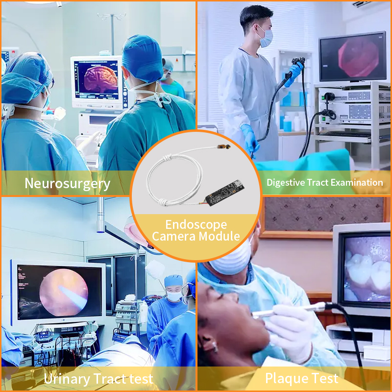 Core Application Advantages of Endoscopic Camera Module in the Surgical Platform